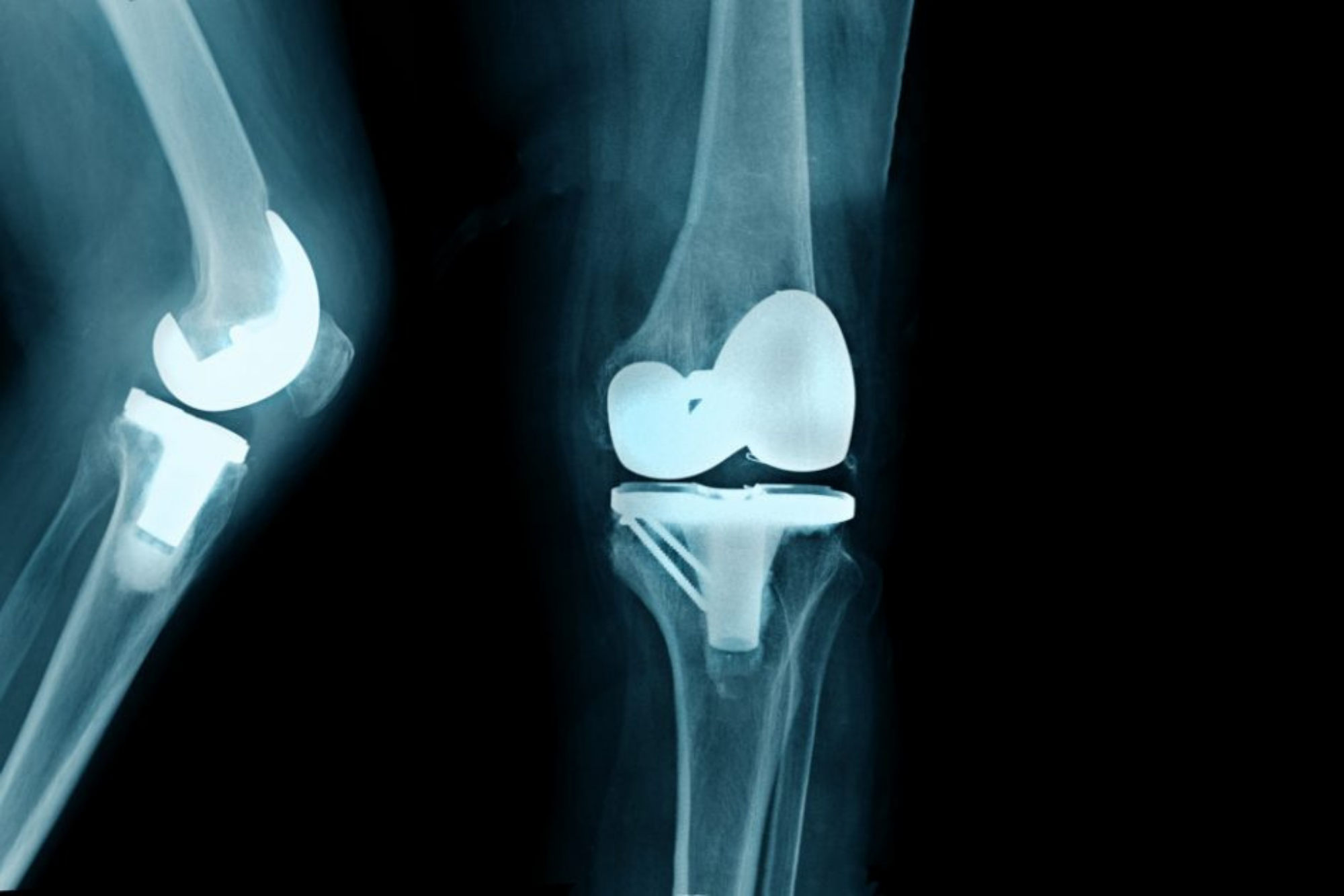 Ростов замена коленного сустава. Total diz Protezi x ray.